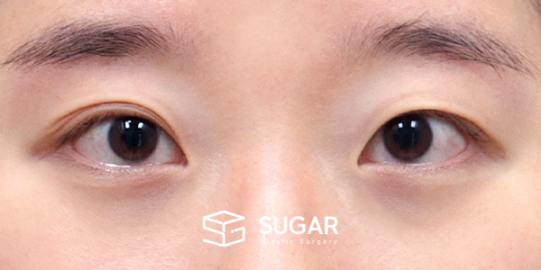 SUGAR整形外科 術前術後案例 #1264 術前術後照片 - 術前