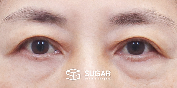 SUGAR整形外科 術前術後案例 #1285 術前術後照片 - 術前