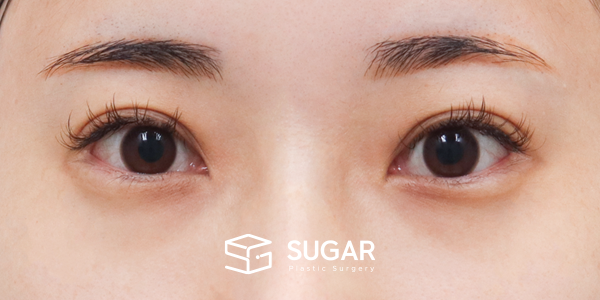 SUGAR整形外科 術前術後案例 #1208 術前術後照片 - 術前