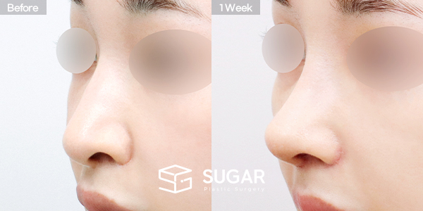 SUGAR整形外科 術前術後案例 #1452 術前術後照片 - 45度術前術後比較