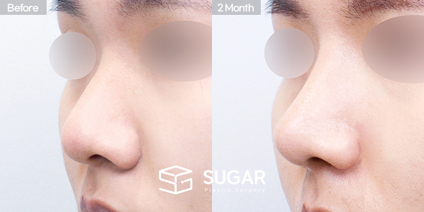 SUGAR整形外科 術前術後案例 #1468 術前術後照片 - 45度術前術後比較