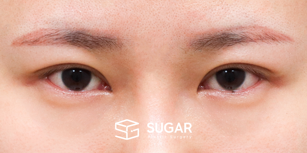 SUGAR整形外科 術前術後案例 #1204 術前術後照片 - 術後
