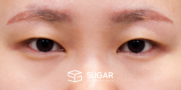 SUGAR整形外科 術前術後案例 #1204 術前術後照片 - 術前