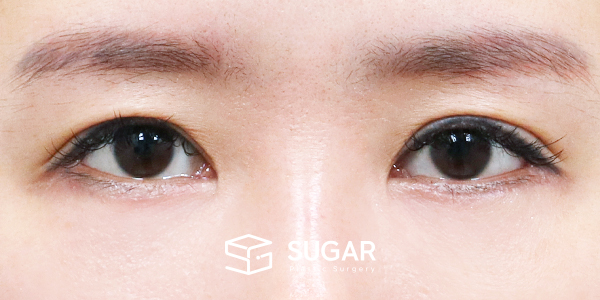 SUGAR整形外科 術前術後案例 #1441 術前術後照片 - 術後