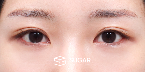 SUGAR整形外科 術前術後案例 #1286 術前術後照片 - 術後