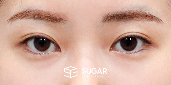 SUGAR整形外科 術前術後案例 #1183 術前術後照片 - 術前