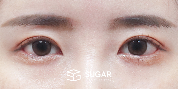 SUGAR整形外科 術前術後案例 #1275 術前術後照片 - 術後