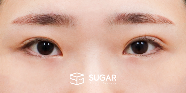 SUGAR整形外科 術前術後案例 #1263 術前術後照片 - 術前