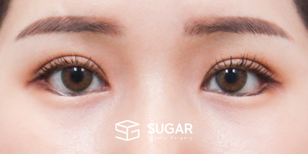SUGAR整形外科 術前術後案例 #1265 術前術後照片 - 術後