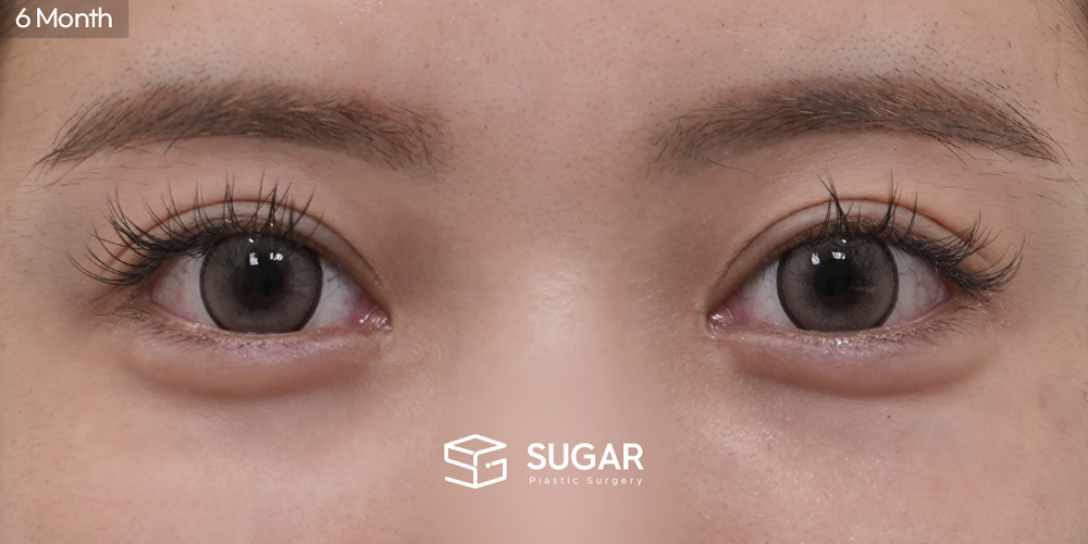 SUGAR整形外科 切開雙眼皮 術前術後照片 - 術後