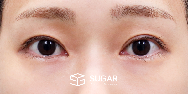 SUGAR整形外科 術前術後案例 #1207 術前術後照片 - 術前