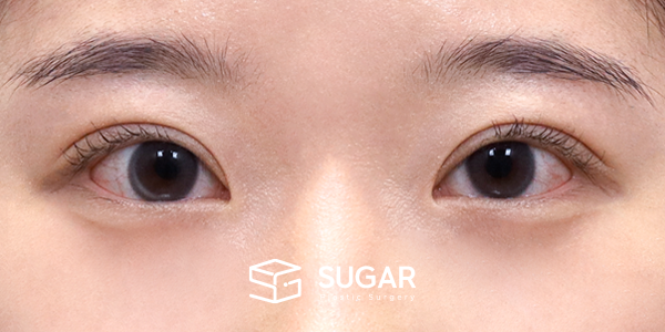 SUGAR整形外科 術前術後案例 #1264 術前術後照片 - 術後