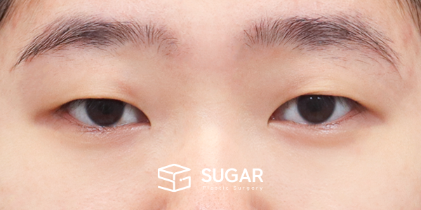 SUGAR整形外科 術前術後案例 #1210 術前術後照片 - 術前