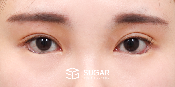 SUGAR整形外科 術前術後案例 #1175 術前術後照片 - 術後