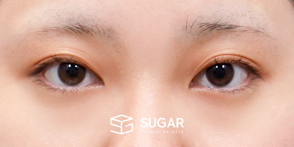 SUGAR整形外科 術前術後案例 #1209 術前術後照片 - 術前
