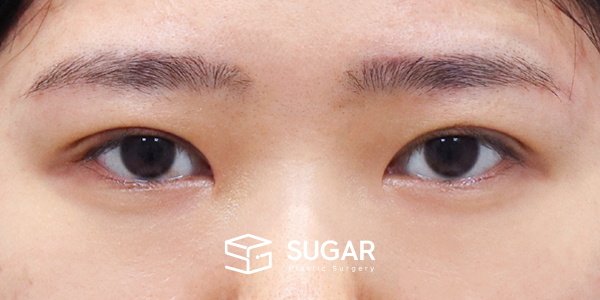 SUGAR整形外科 術前術後案例 #1210 術前術後照片 - 術後