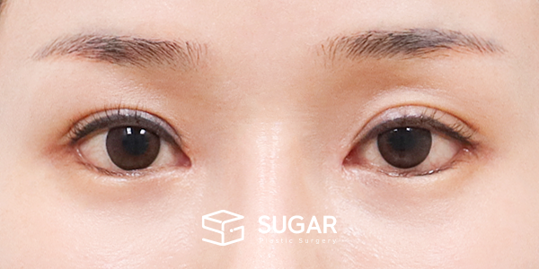 SUGAR整形外科 術前術後案例 #1180 術前術後照片 - 術後