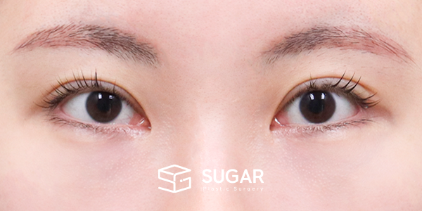SUGAR整形外科 術前術後案例 #1206 術前術後照片 - 術前