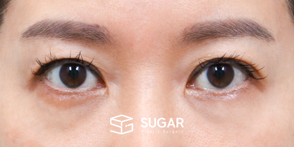 SUGAR整形外科 術前術後案例 #1277 術前術後照片 - 術前
