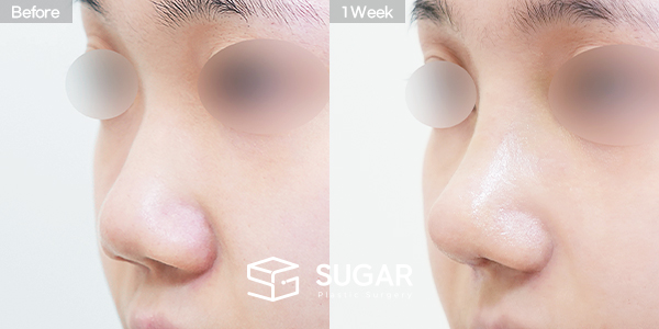SUGAR整形外科 術前術後案例 #1456 術前術後照片 - 45度術前術後比較
