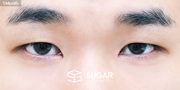 SUGAR整形外科 術前術後案例 #1477 術前術後照片 - 術後