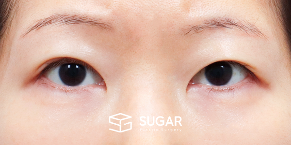 SUGAR整形外科 術前術後案例 #1173 術前術後照片 - 術前
