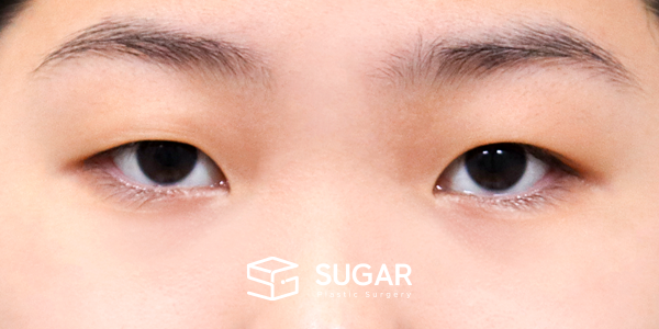 SUGAR整形外科 術前術後案例 #1201 術前術後照片 - 術前