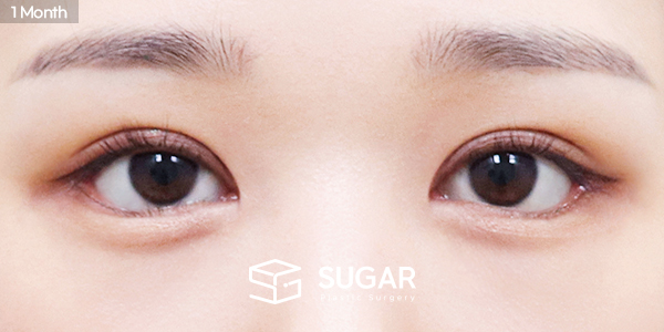 SUGAR整形外科 術前術後案例 #1458 術前術後照片 - 術後