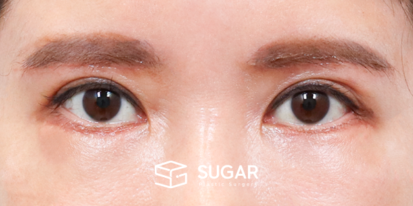 SUGAR整形外科 術前術後案例 #1277 術前術後照片 - 術後