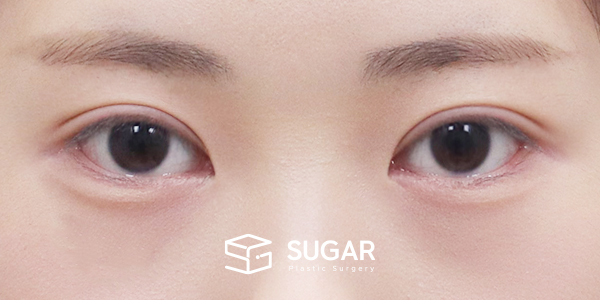SUGAR整形外科 術前術後案例 #1212 術前術後照片 - 術後