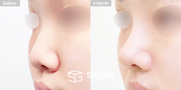 SUGAR整形外科 術前術後案例 #1454 術前術後照片 - 45度術前術後比較