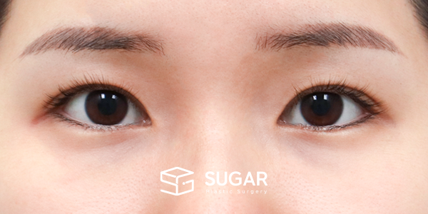 SUGAR整形外科 術前術後案例 #1265 術前術後照片 - 術前