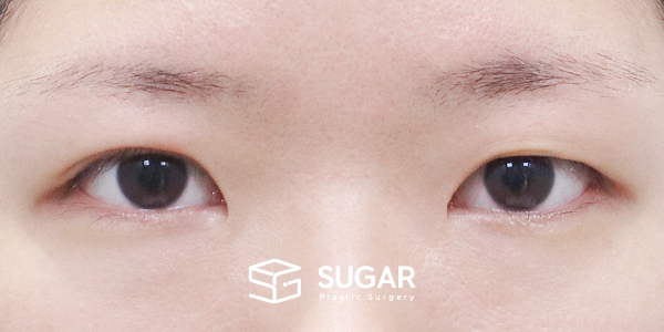 SUGAR整形外科 術前術後案例 #1284 術前術後照片 - 術前