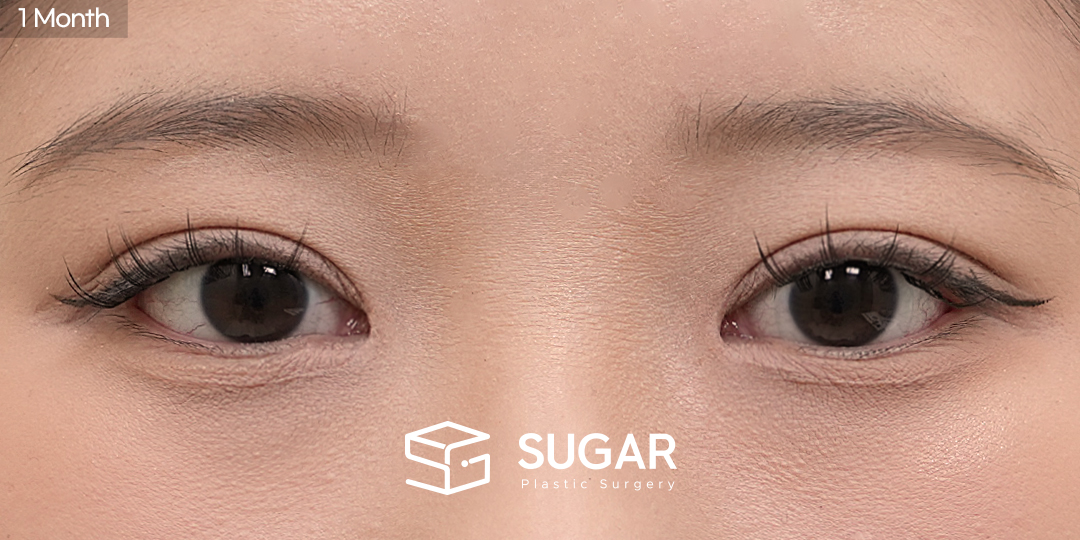 SUGAR整形外科 術前術後案例 #1570 術前術後照片 - 術後