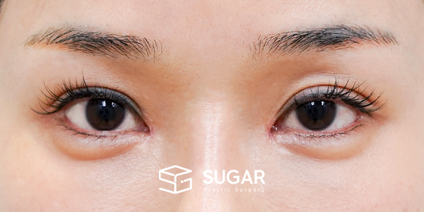 SUGAR整形外科 術前術後案例 #1180 術前術後照片 - 術前