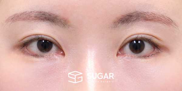 SUGAR整形外科 術前術後案例 #1206 術前術後照片 - 術後