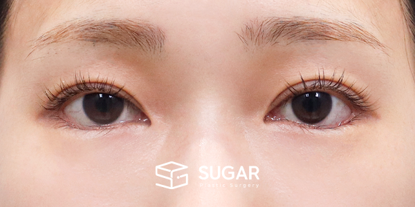 SUGAR整形外科 術前術後案例 #1207 術前術後照片 - 術後