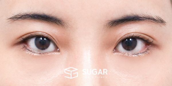 SUGAR整形外科 術前術後案例 #1274 術前術後照片 - 術後