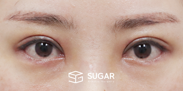 SUGAR整形外科 術前術後案例 #1271 術前術後照片 - 術後