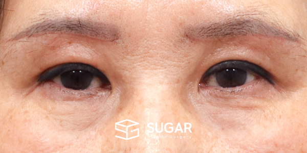 SUGAR整形外科 術前術後案例 #1211 術前術後照片 - 術後