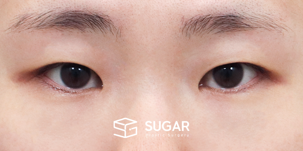 SUGAR整形外科 術前術後案例 #1269 術前術後照片 - 術前