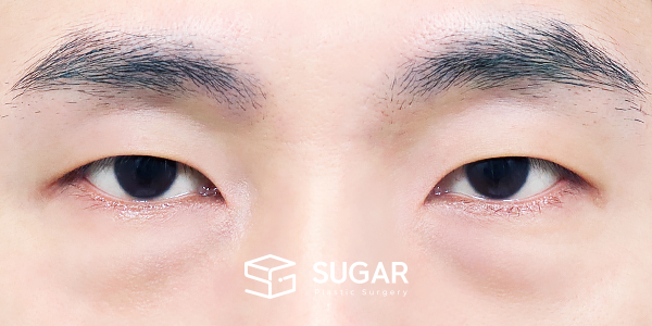 SUGAR整形外科 術前術後案例 #1432 術前術後照片 - 術前