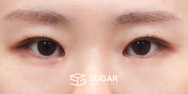 SUGAR整形外科 術前術後案例 #1269 術前術後照片 - 術後