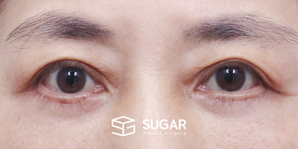 SUGAR整形外科 術前術後案例 #1285 術前術後照片 - 術後