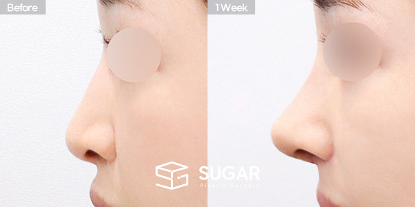 SUGAR整形外科 術前術後案例 #1452 術前術後照片 - 側面術前術後比較