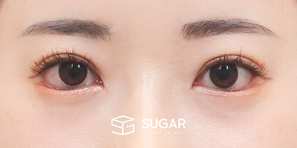 SUGAR整形外科 術前術後案例 #1208 術前術後照片 - 術後