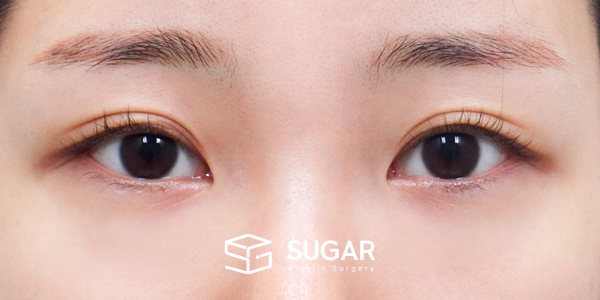 SUGAR整形外科 術前術後案例 #1286 術前術後照片 - 術前