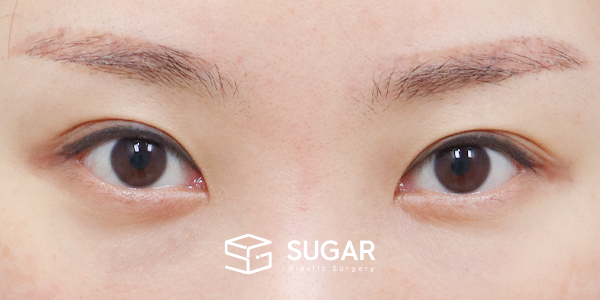 SUGAR整形外科 術前術後案例 #1271 術前術後照片 - 術前