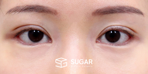 SUGAR整形外科 術前術後案例 #1181 術前術後照片 - 術後