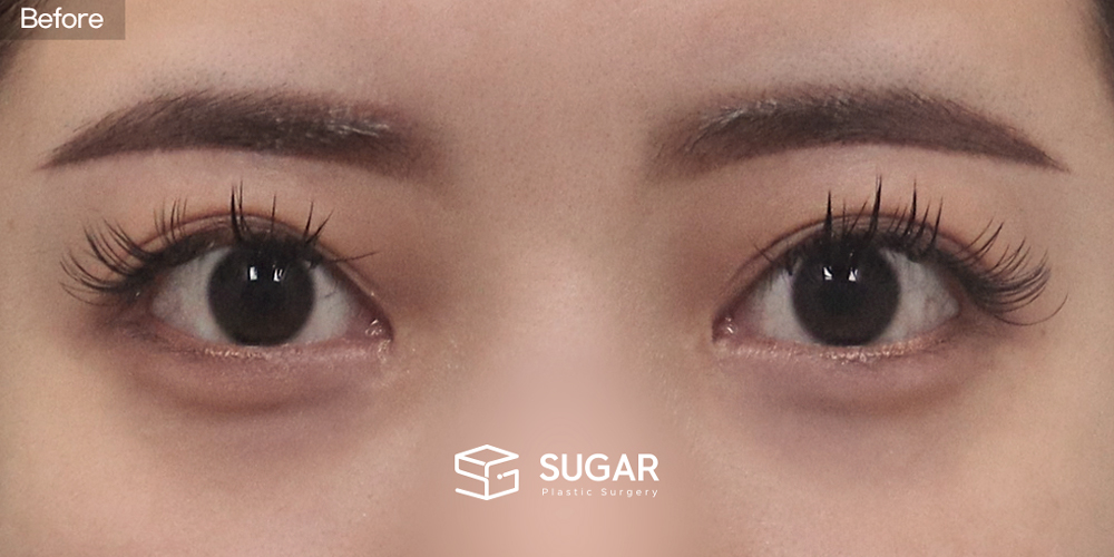 SUGAR整形外科 切開雙眼皮 術前術後照片 - 術前